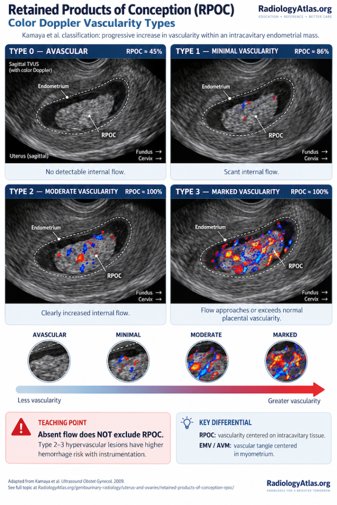 Retained products of conception (RPOC) ultrasound infographic showing Type 0 to Type 3 color Doppler vascularity, from avascular to markedly vascular RPOC.